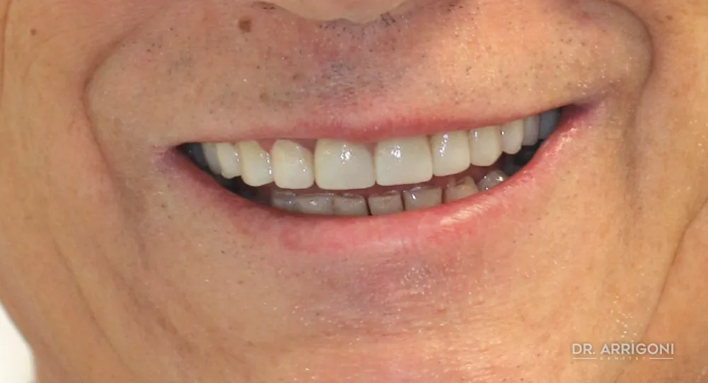 Riabilitazione estetica con faccette e corone — dopo il trattamento