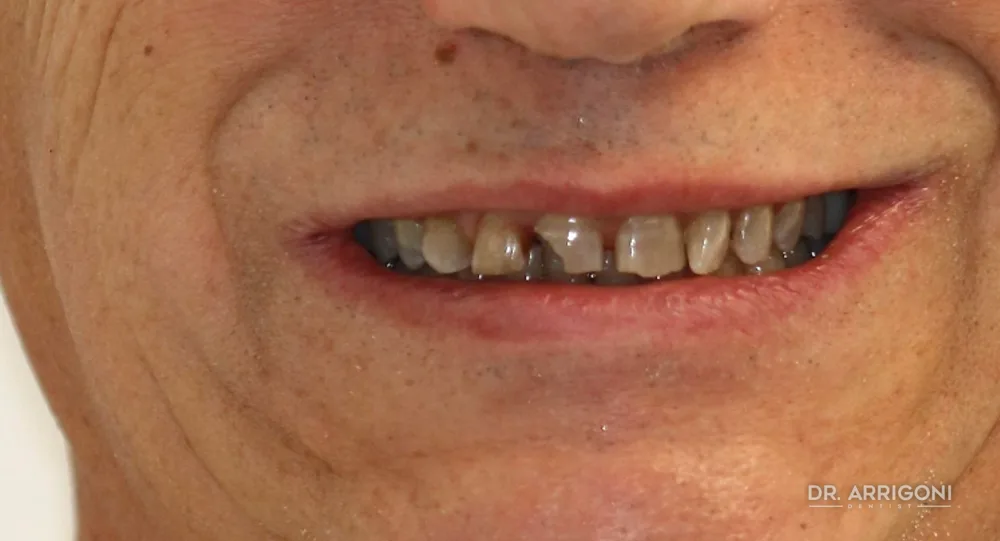 Riabilitazione estetica con faccette e corone — prima del trattamento