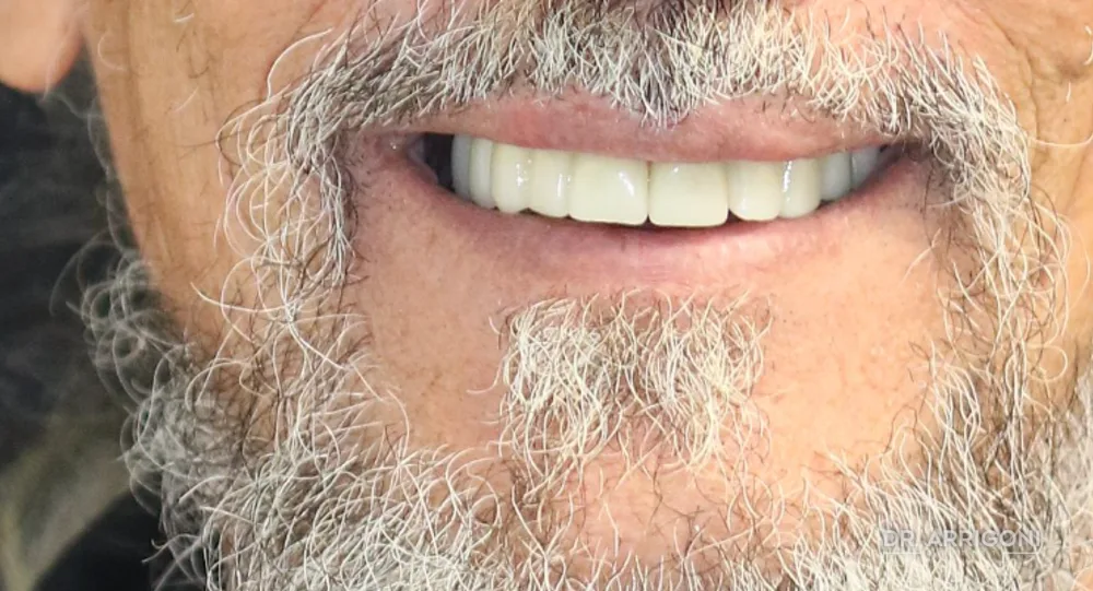 Riabilitazione completa con protesi fissa su impianti — dopo il trattamento