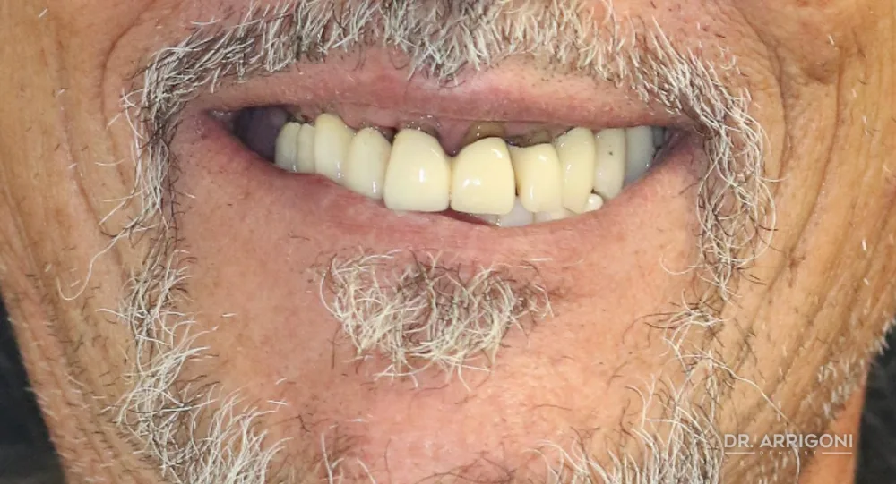 Riabilitazione completa con protesi fissa su impianti — prima del trattamento