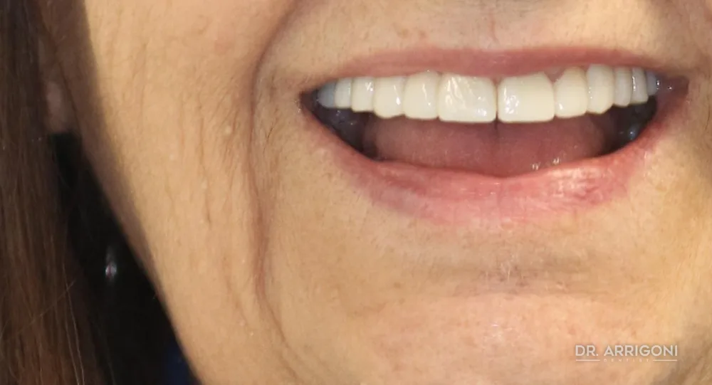Estetica del sorriso, restauro completo — dopo il trattamento