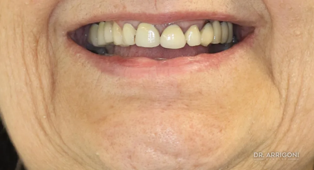 Estetica del sorriso, restauro completo — prima del trattamento