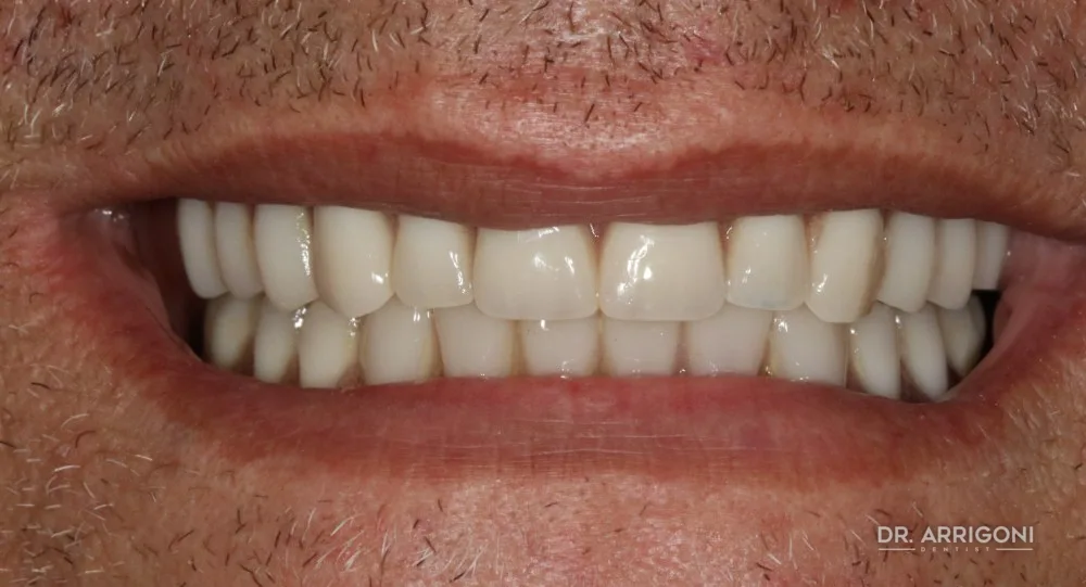 Riabilitazione su impianti con denti fissi — dopo il trattamento