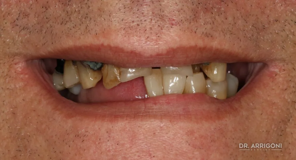Riabilitazione su impianti con denti fissi — prima del trattamento