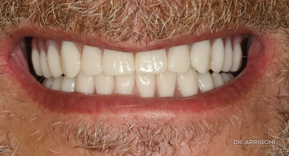 Riabilitazione completa, estetica e funzione — dopo il trattamento