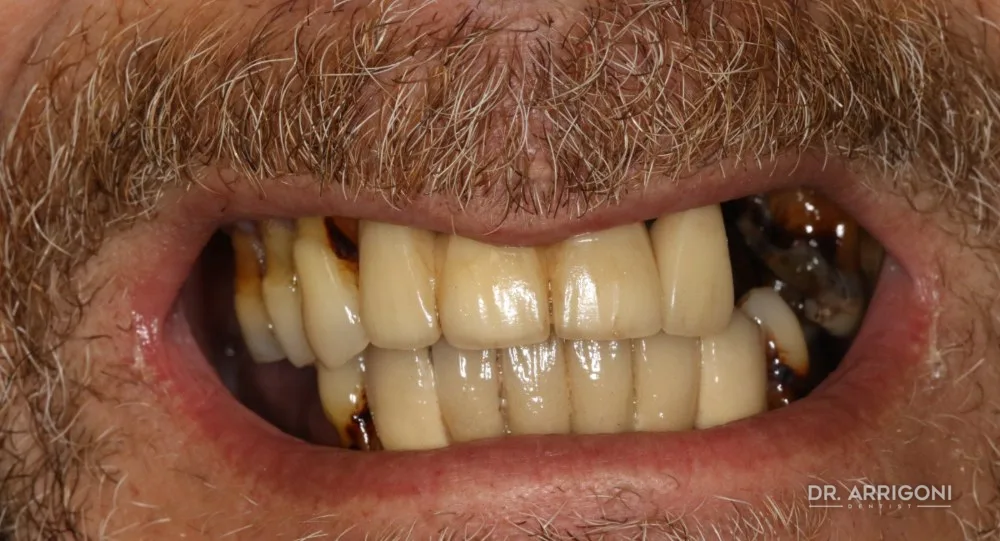 Riabilitazione completa, estetica e funzione — prima del trattamento