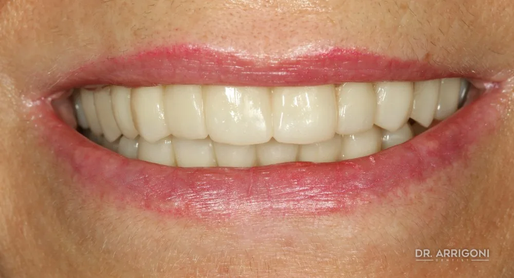 Riabilitazione estetica, denti naturali e armonici — dopo il trattamento