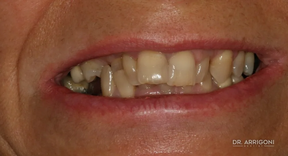 Riabilitazione estetica, denti naturali e armonici — prima del trattamento