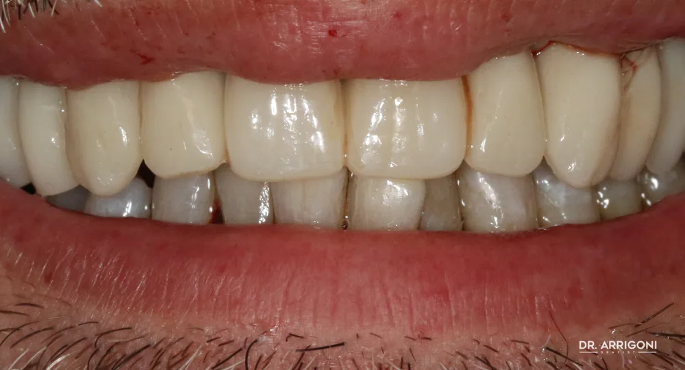 Arcata superiore riabilitata con protesi fissa — dopo il trattamento