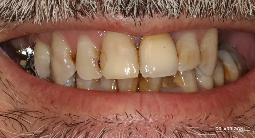 Arcata superiore con denti compromessi e usurati — prima del trattamento