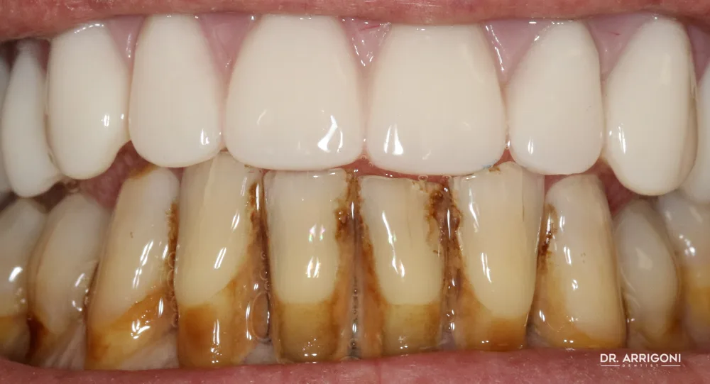 Arcata superiore riabilitata con protesi fissa — dopo il trattamento