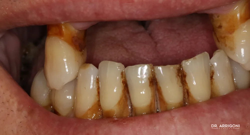 Arcata superiore priva di elementi dentari — prima del trattamento