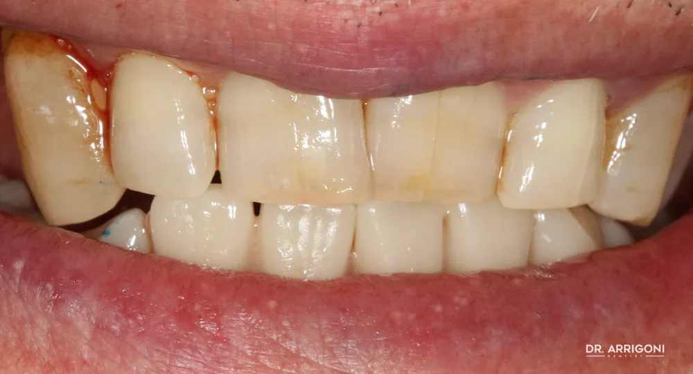 Arcata inferiore riabilitata con protesi fissa — dopo il trattamento