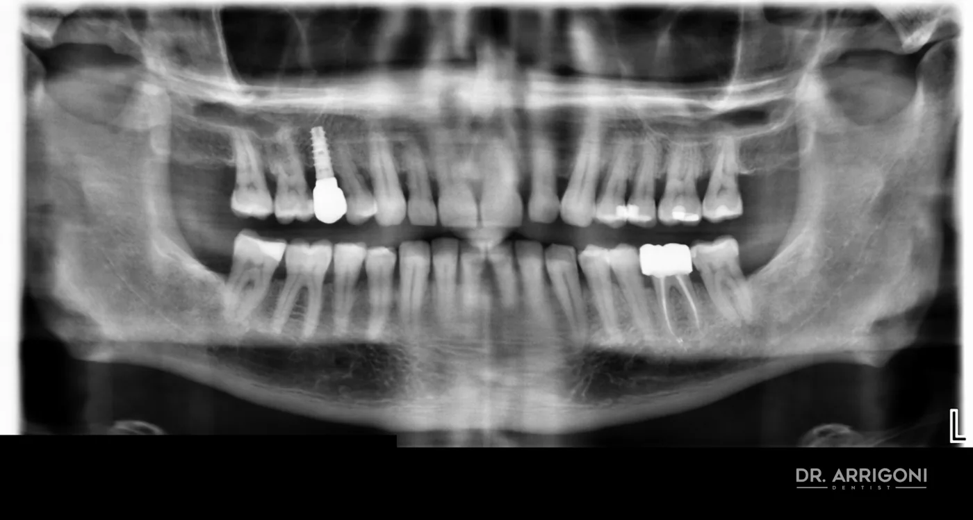 Radiografia panoramica iniziale con cisti periapicale sull'incisivo inferiore