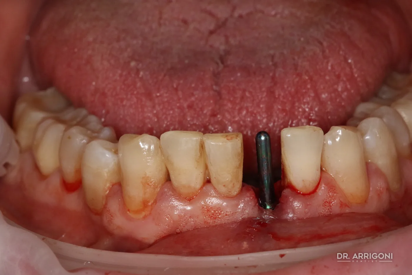Impianto inserito con tecnica flapless