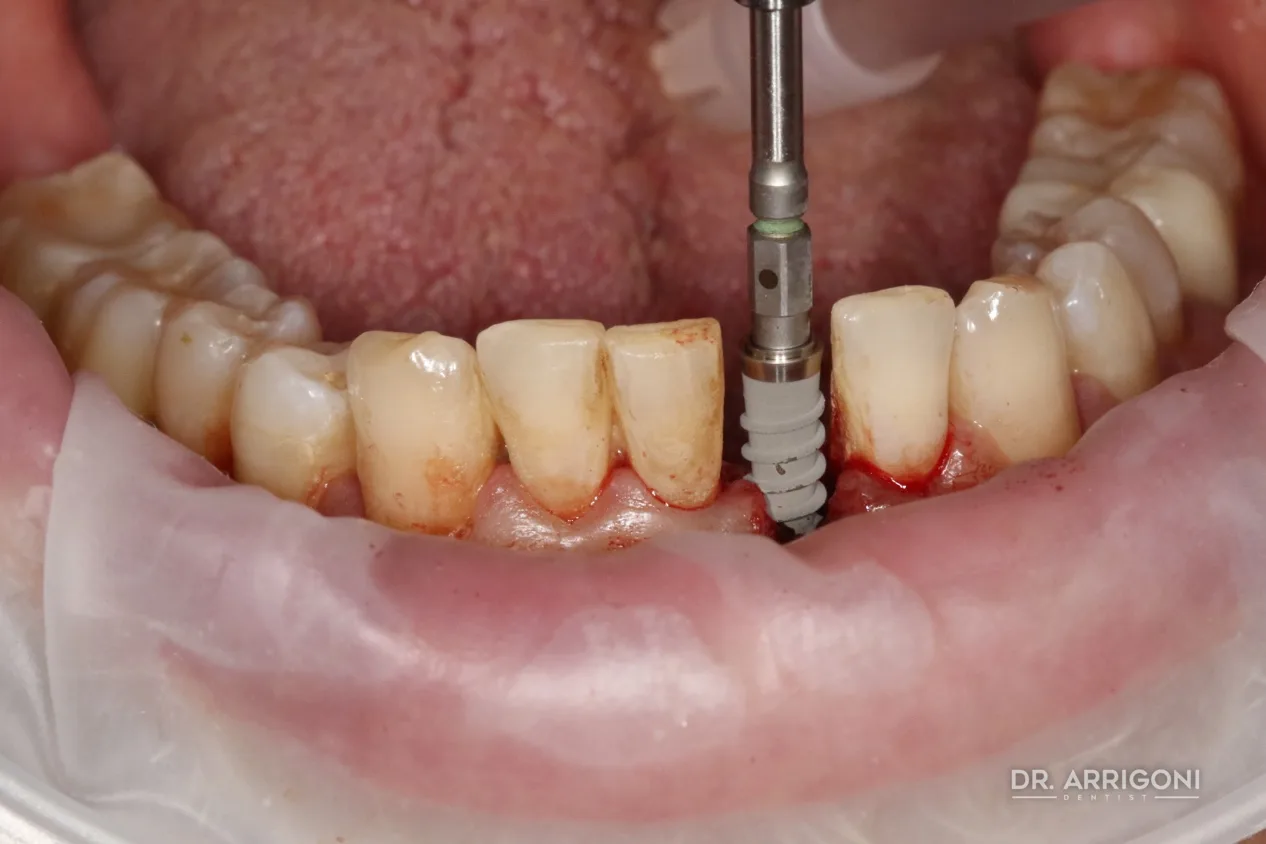 Verifica dell'asse implantare con pin di parallelismo