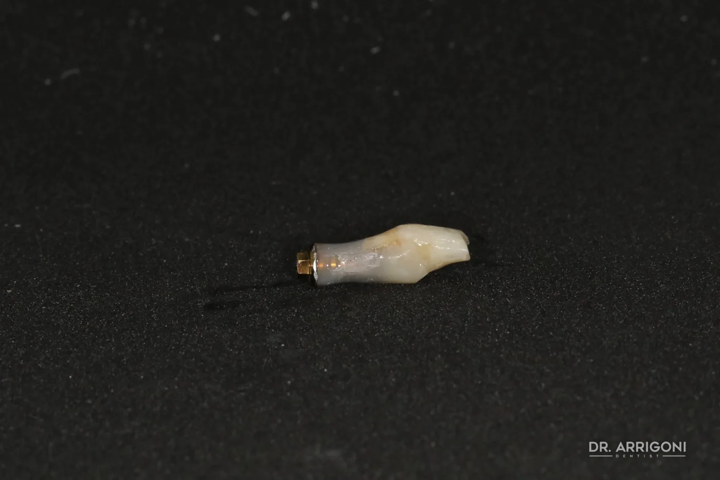Il dente naturale estratto, poi riutilizzato come provvisorio