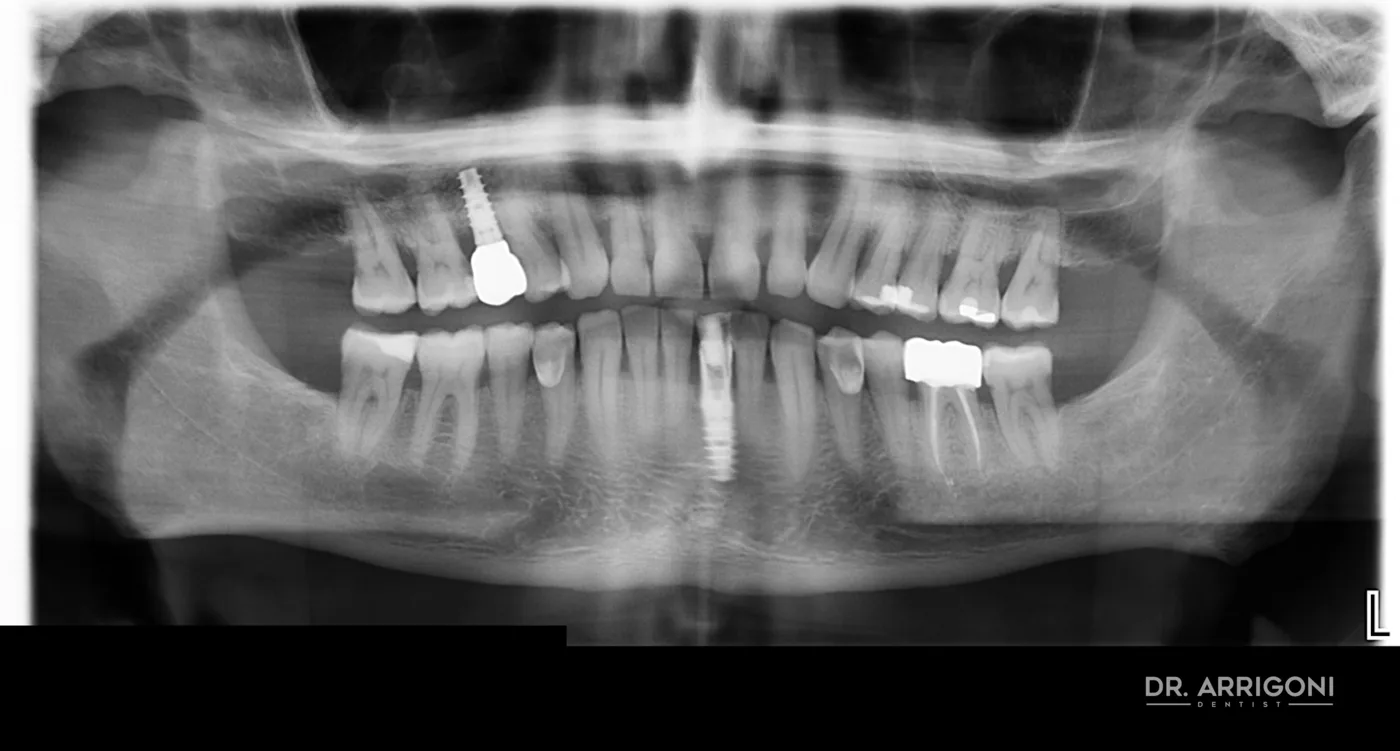 Radiografia di controllo al follow-up