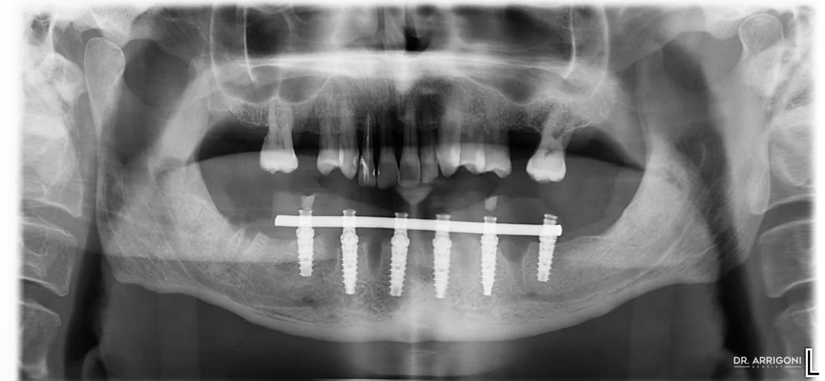 Radiografia panoramica finale: sei impianti mandibolari collegati da barra avvitata