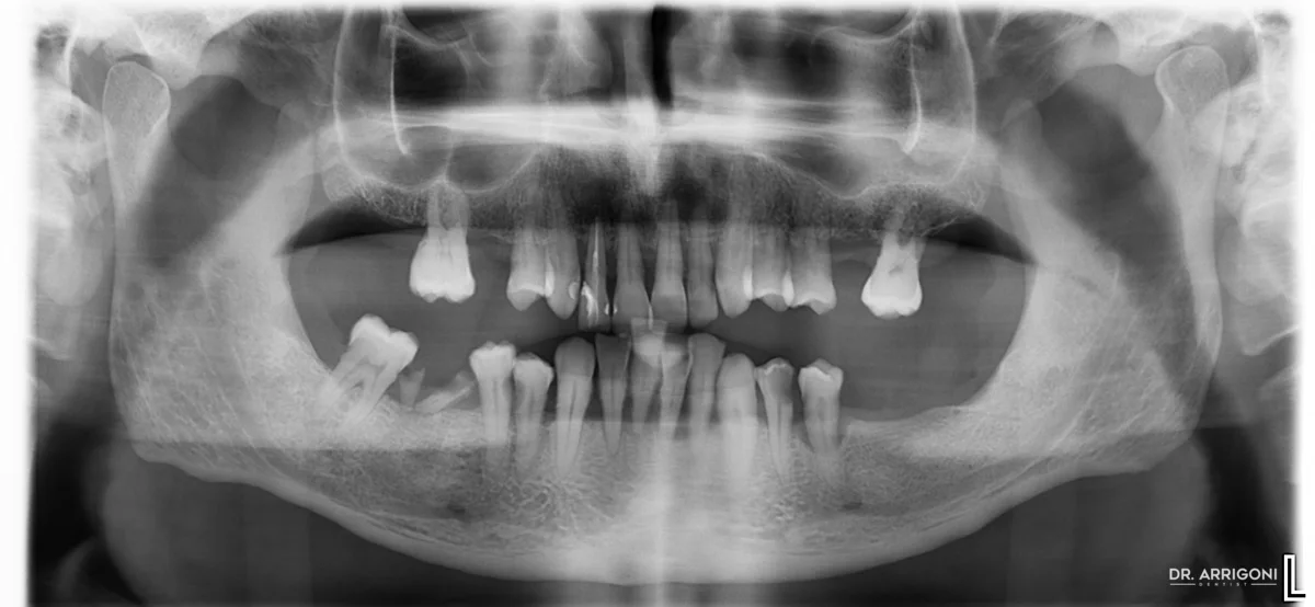 Radiografia panoramica iniziale: dentatura compromessa con grave perdita di supporto osseo