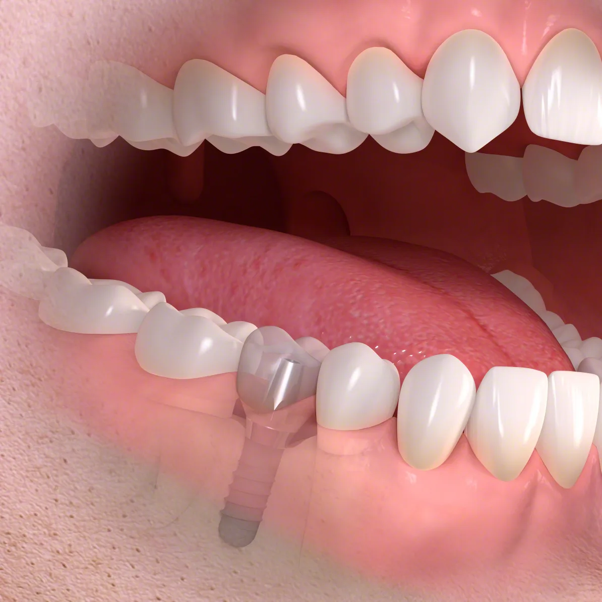 Inserimento di un impianto dentale in modo mini-invasivo
