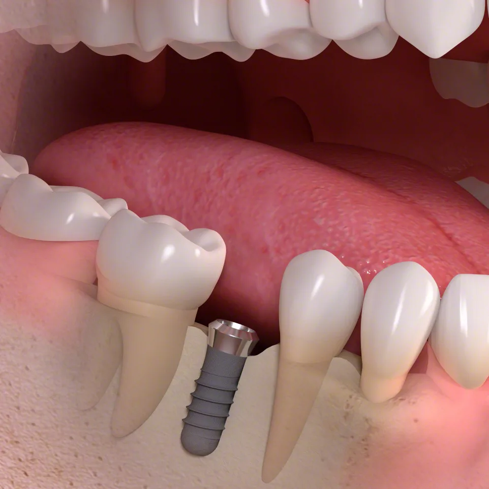 Impianto dentale integrato nell'osso mascellare