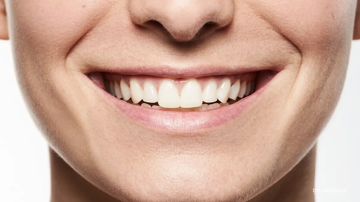 Sorriso naturale con faccette in ceramica disilicato di litio