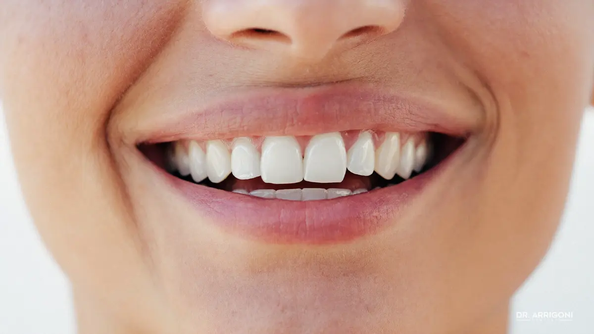 Sorriso naturale ottenuto con faccette dentali senza limatura