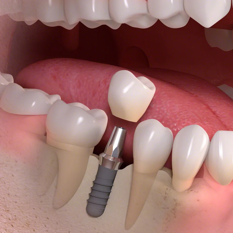 Impianto dentale con corona in una fase del trattamento