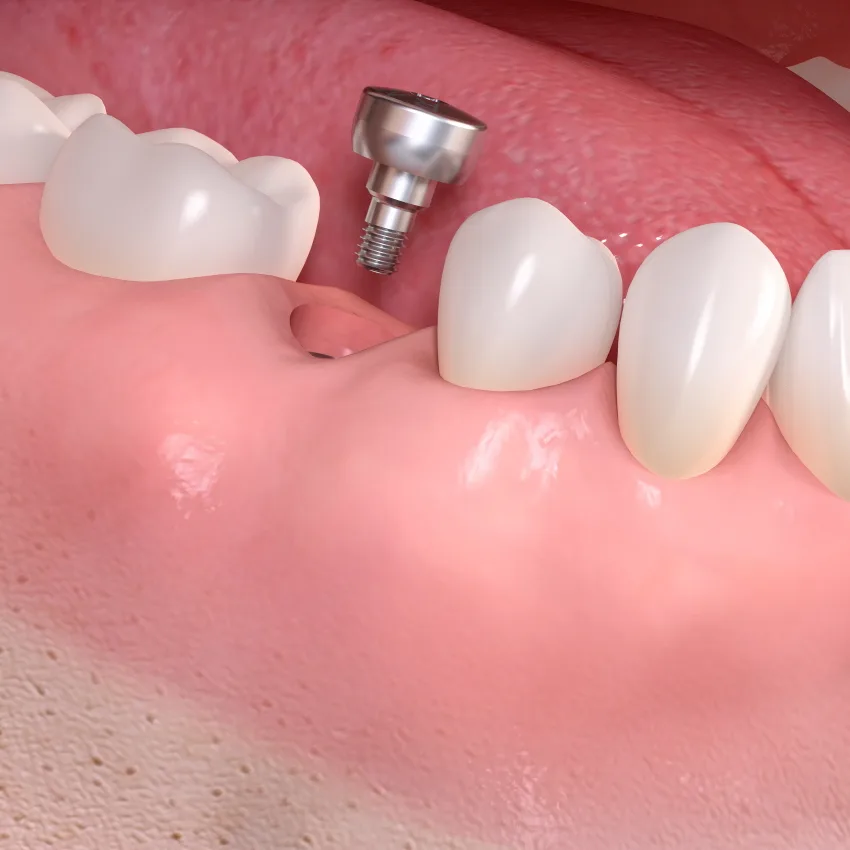 Chirurgia orale e rigenerazione ossea — illustrazione clinica