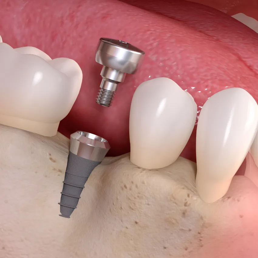 Chirurgia orale e rigenerazione ossea — illustrazione clinica