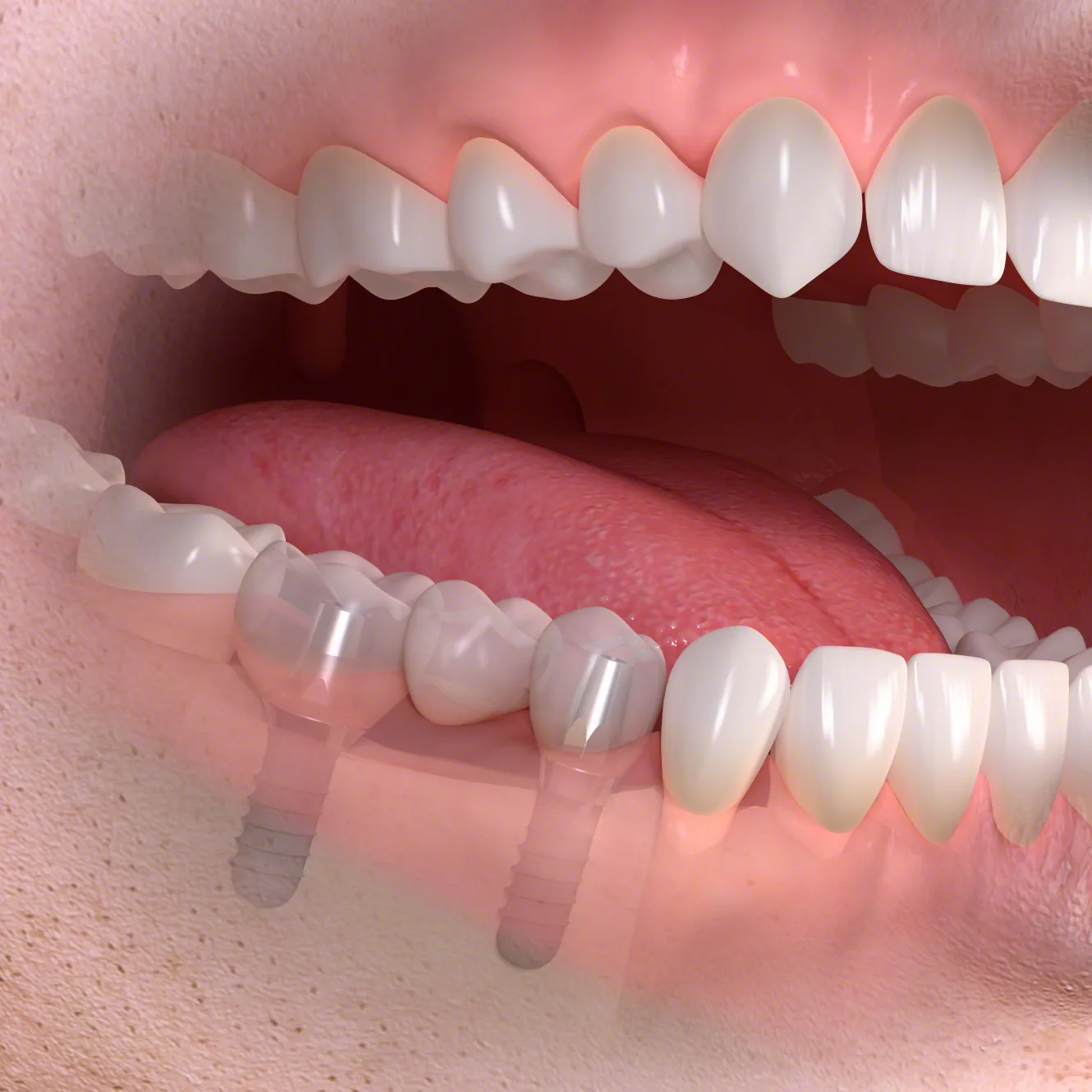 Impianto dentale — illustrazione clinica di odontoiatria digitale