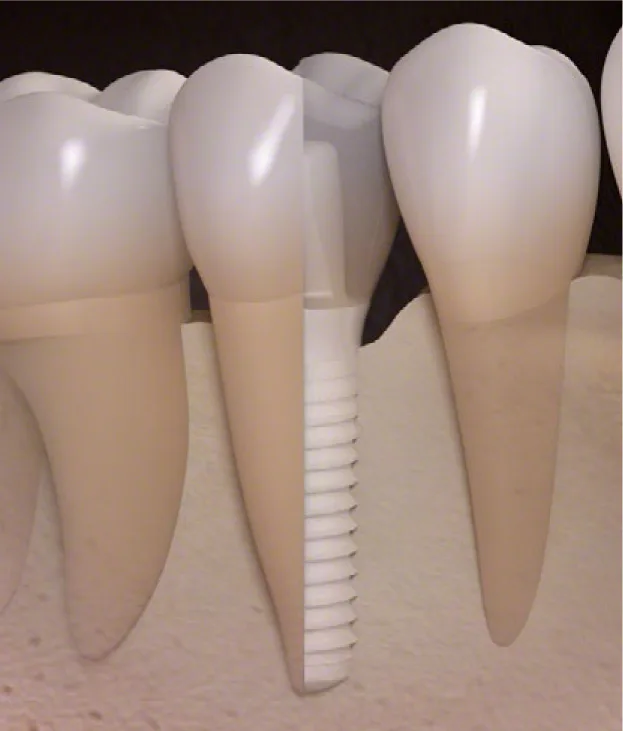 Impianto dentale — illustrazione clinica di odontoiatria digitale