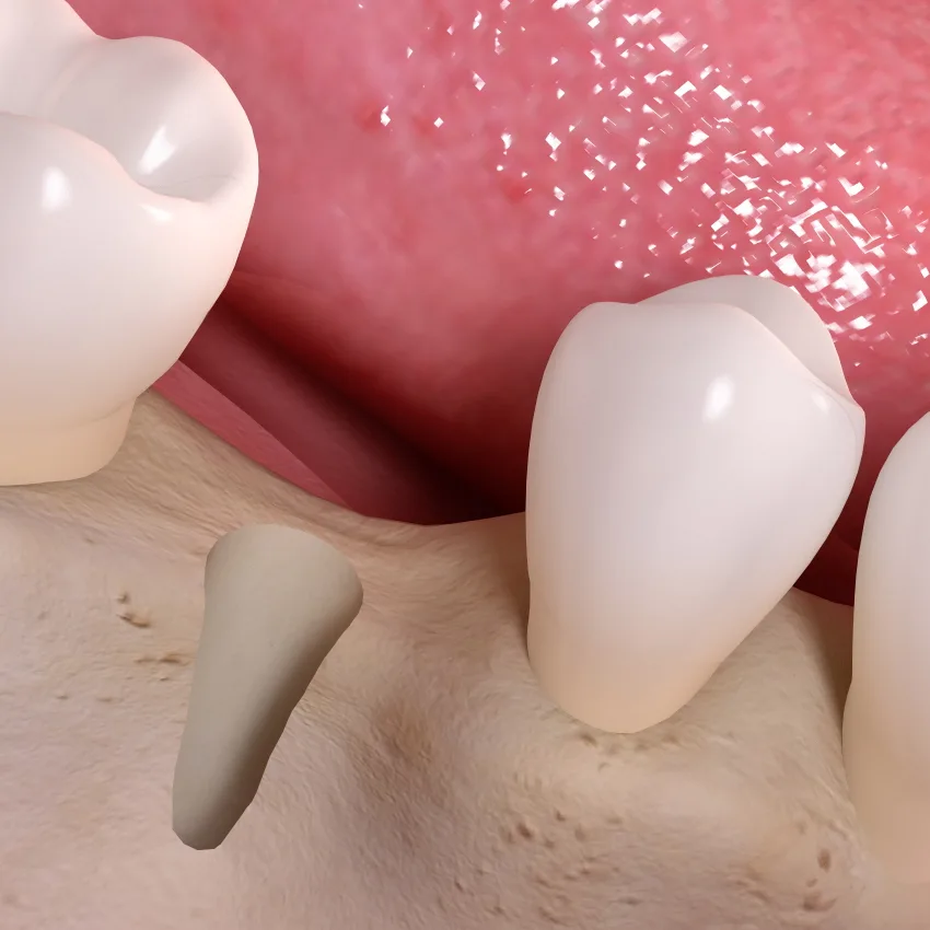 Innesto di materiale osseo nel sito implantare