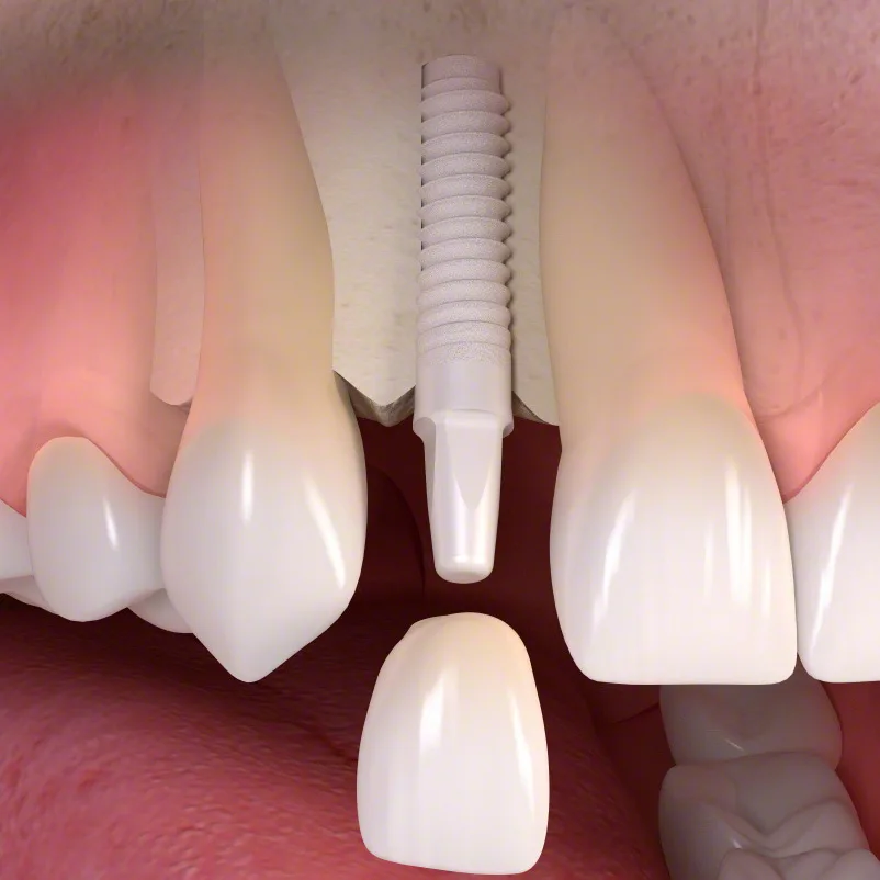 Impianto dentale guarito con corona in ceramica