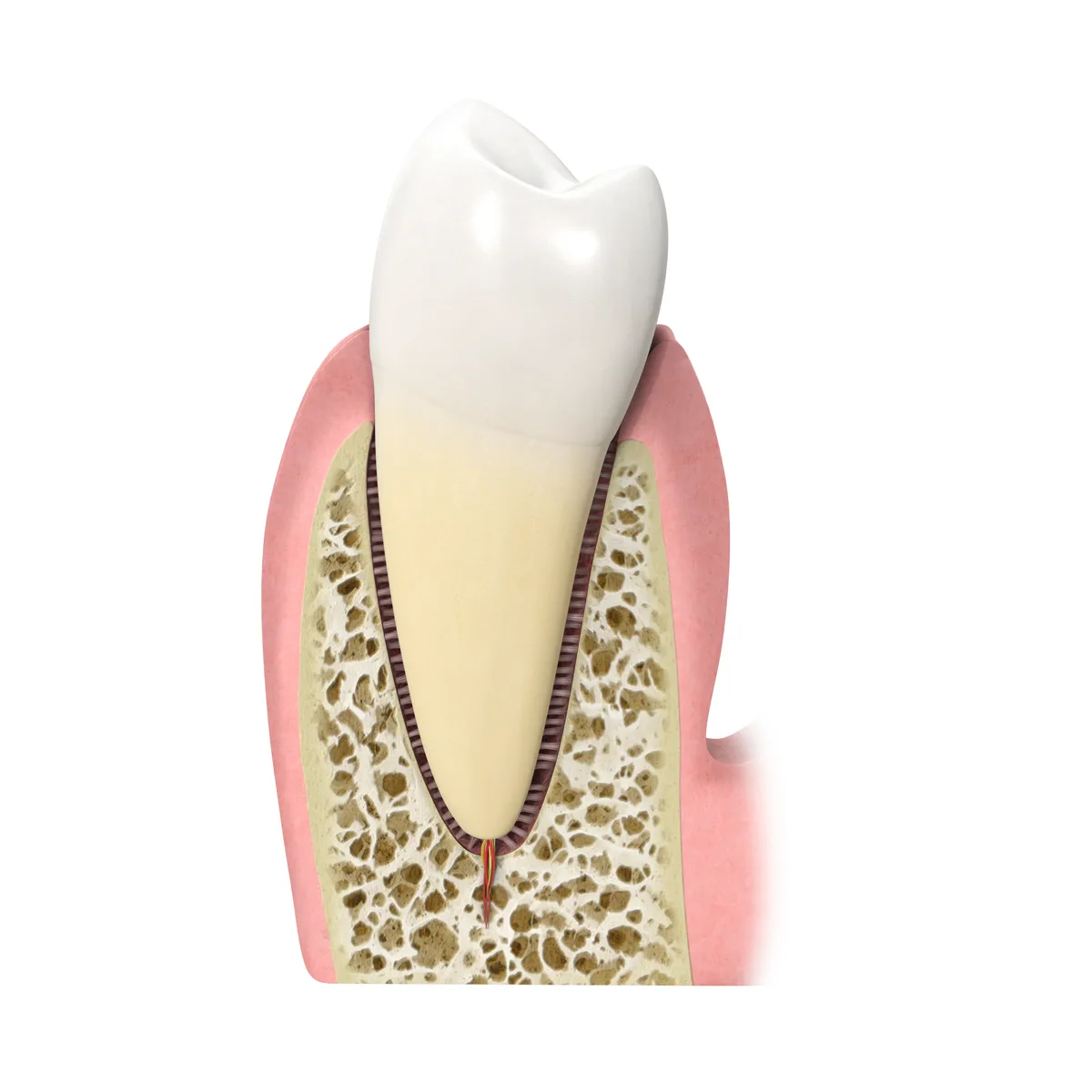 Sezione di dente e osso nella malattia parodontale